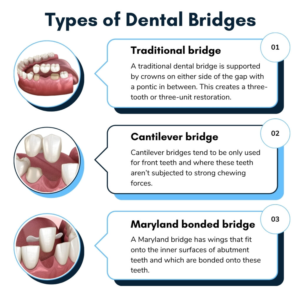dental bridge types